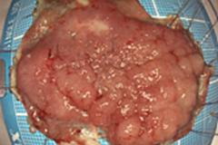 内視鏡的粘膜下層剥離術（大腸ESD）