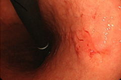 内視鏡的粘膜下層剥離術（食道・胃ESD）