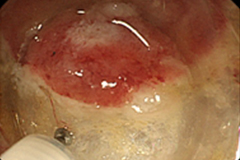 内視鏡的粘膜下層剥離術（食道・胃ESD）