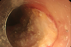 内視鏡的粘膜下層剥離術（食道・胃ESD）