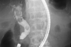 ダブルバルーン(DBE)によるERCP