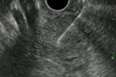 超音波内視鏡 超音波内視鏡下生検(EUS-FNA)