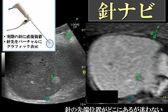 ラジオ波焼灼術