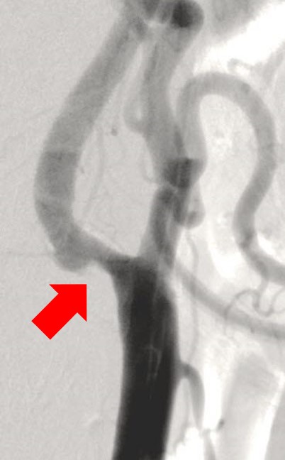 頚動脈ステント前_頚部血管が原因で脳梗塞を生じた