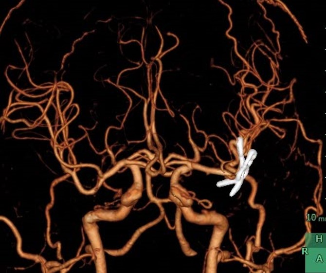 動脈瘤クリッピング後<br>クリッピングにて瘤は消失し、脳血管にバイパス手術も行われている