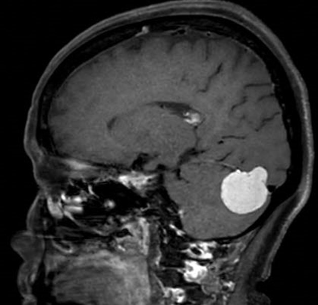 腫瘍切除術前_腫瘍が小脳、後頭葉を圧排している