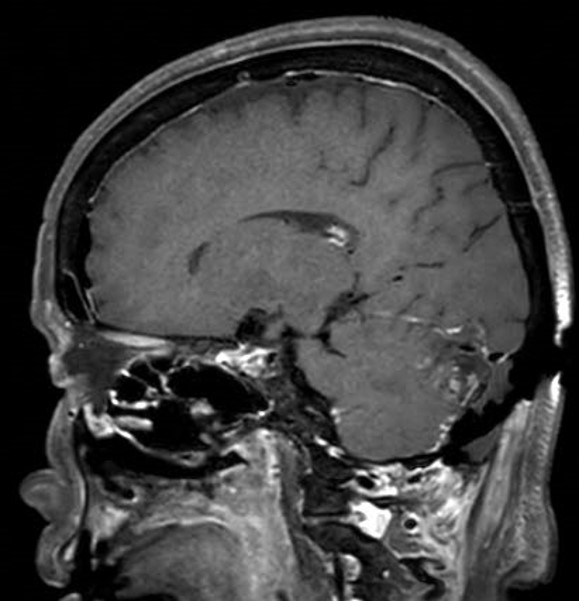 腫瘍切除術後_腫瘍が切除されている