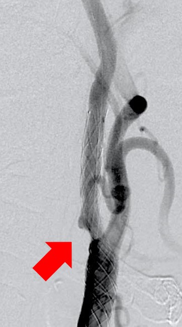 頚動脈ステント後_狭窄部が拡張している
