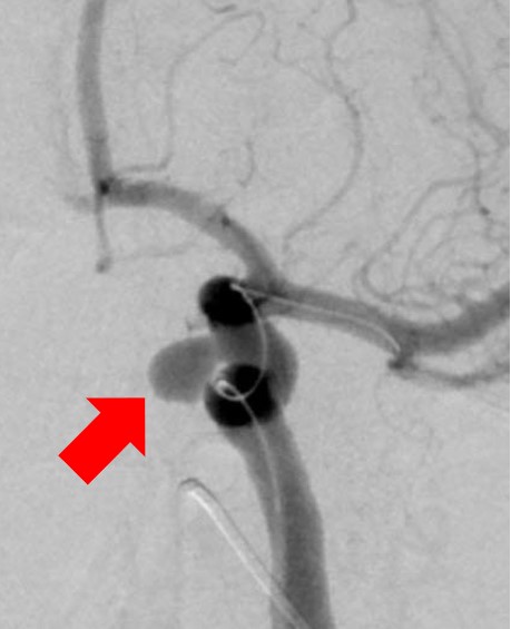 動脈瘤ステントコイル前_脳血管に瘤を認める
