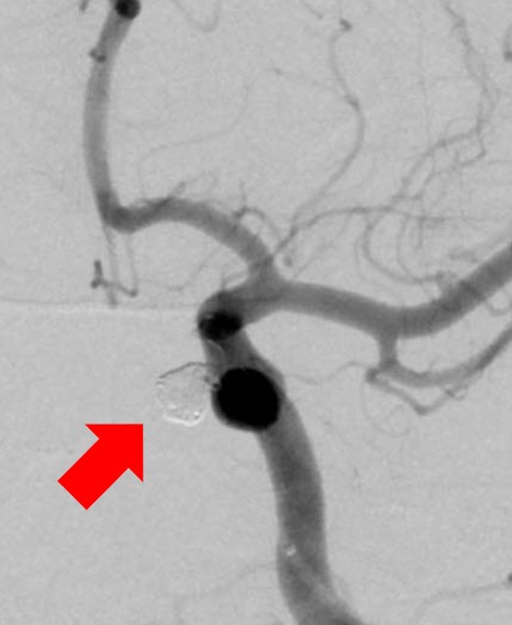 動脈瘤ステントコイル後_瘤は描出されない