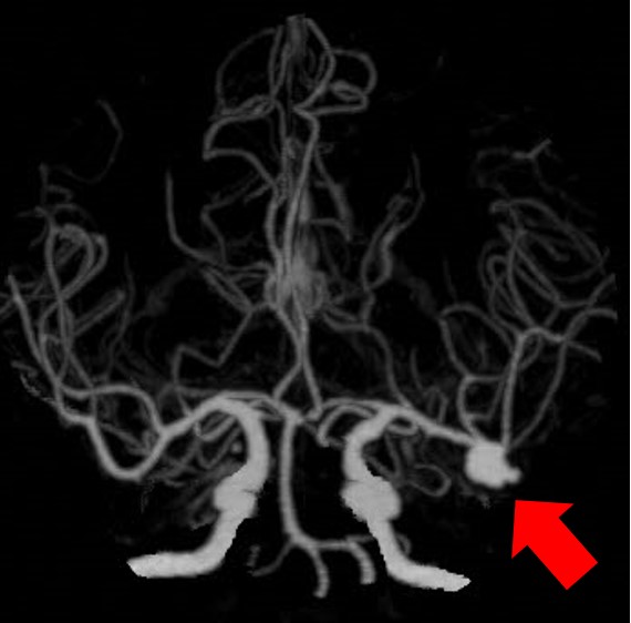 動脈瘤クリッピング前_脳動脈に瘤を認める