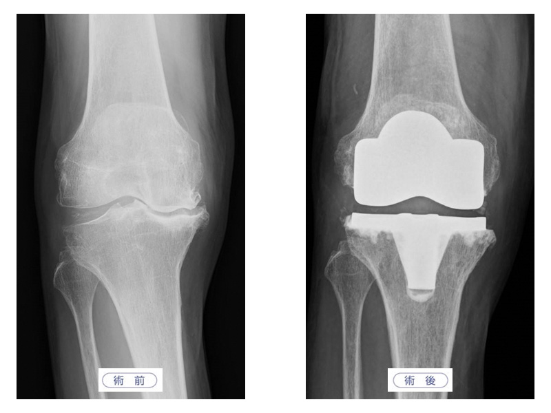 人工膝関節置換術