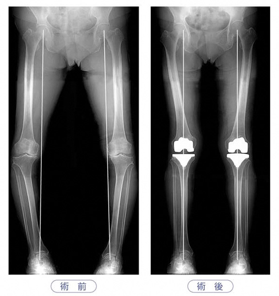 人工膝関節置換術