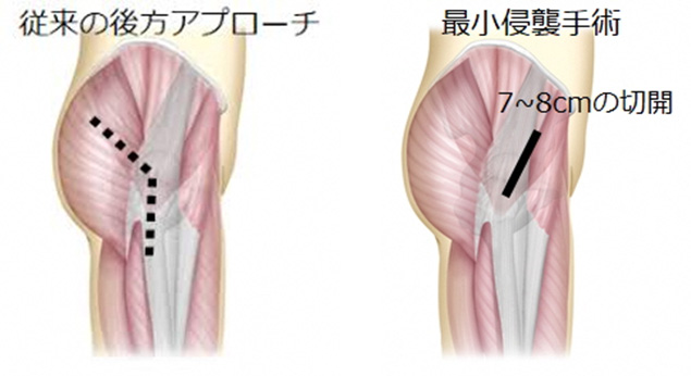 人工股関節置換術