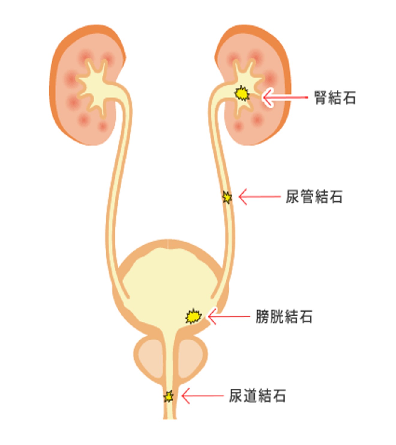 尿路結石