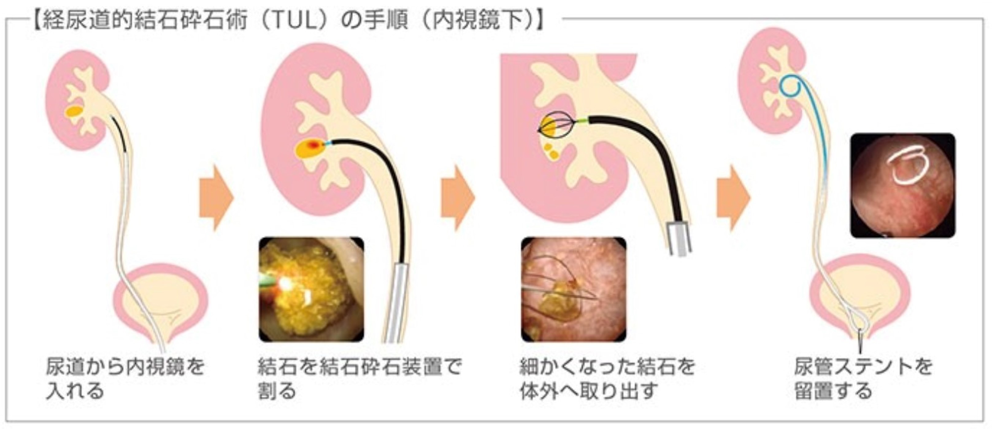 TUL（経尿道的腎尿管砕石術）